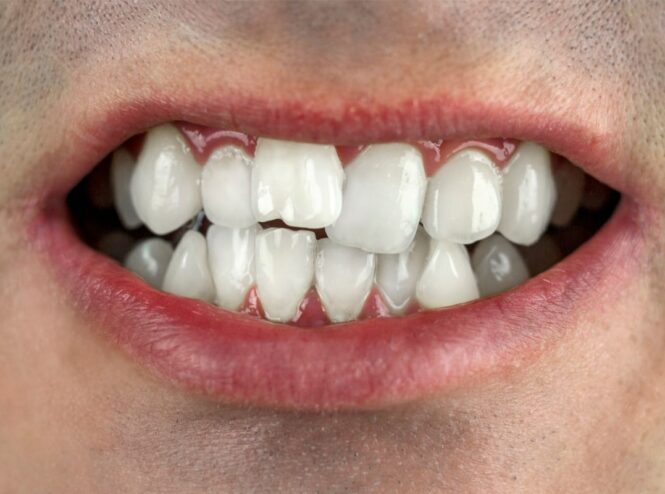 Tratamento Ortodôntico para Adultos alinharem o sorriso