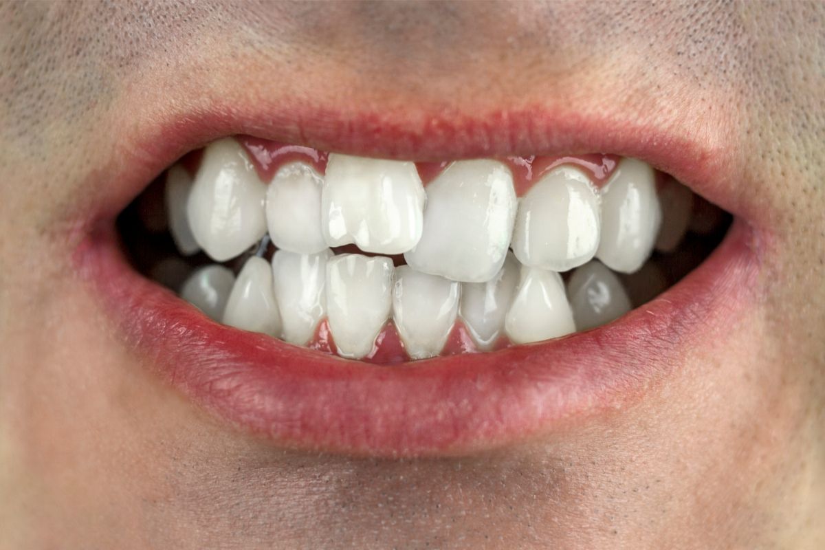 Tratamento Ortodôntico para Adultos alinharem o sorriso