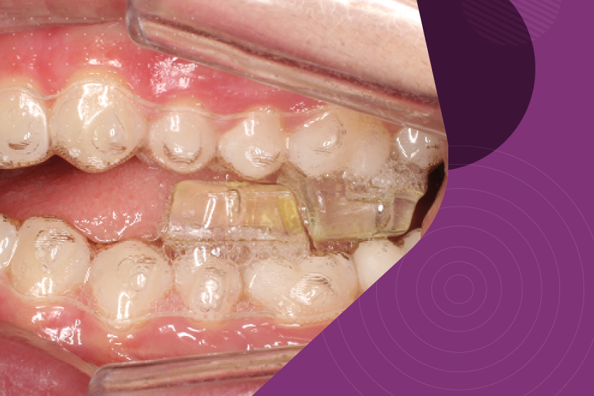 alinhadores invisalign tecnologia ortodontia digital